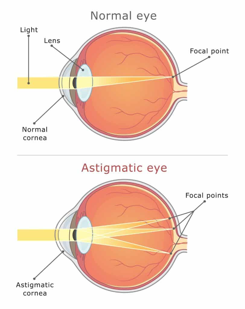 Your Options for Correcting Astigmatism During Cataract Surgery ...